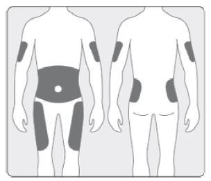 iPort insertion sites